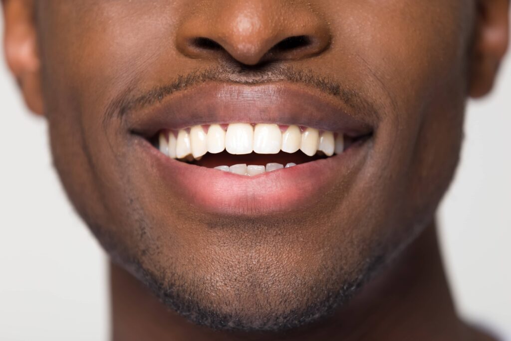 Close up view of beaming orthodontic white wide male smile, african black man with healthy straight clean teeth