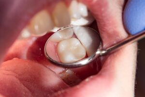 two chewing side teeth of the upper jaw after treatment of caries