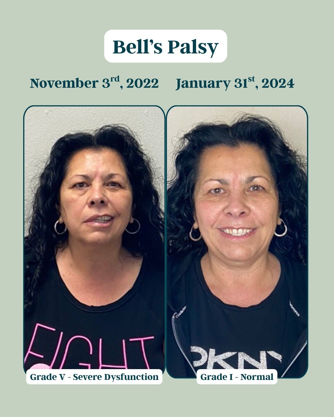 Before and After Bells Palsy 1