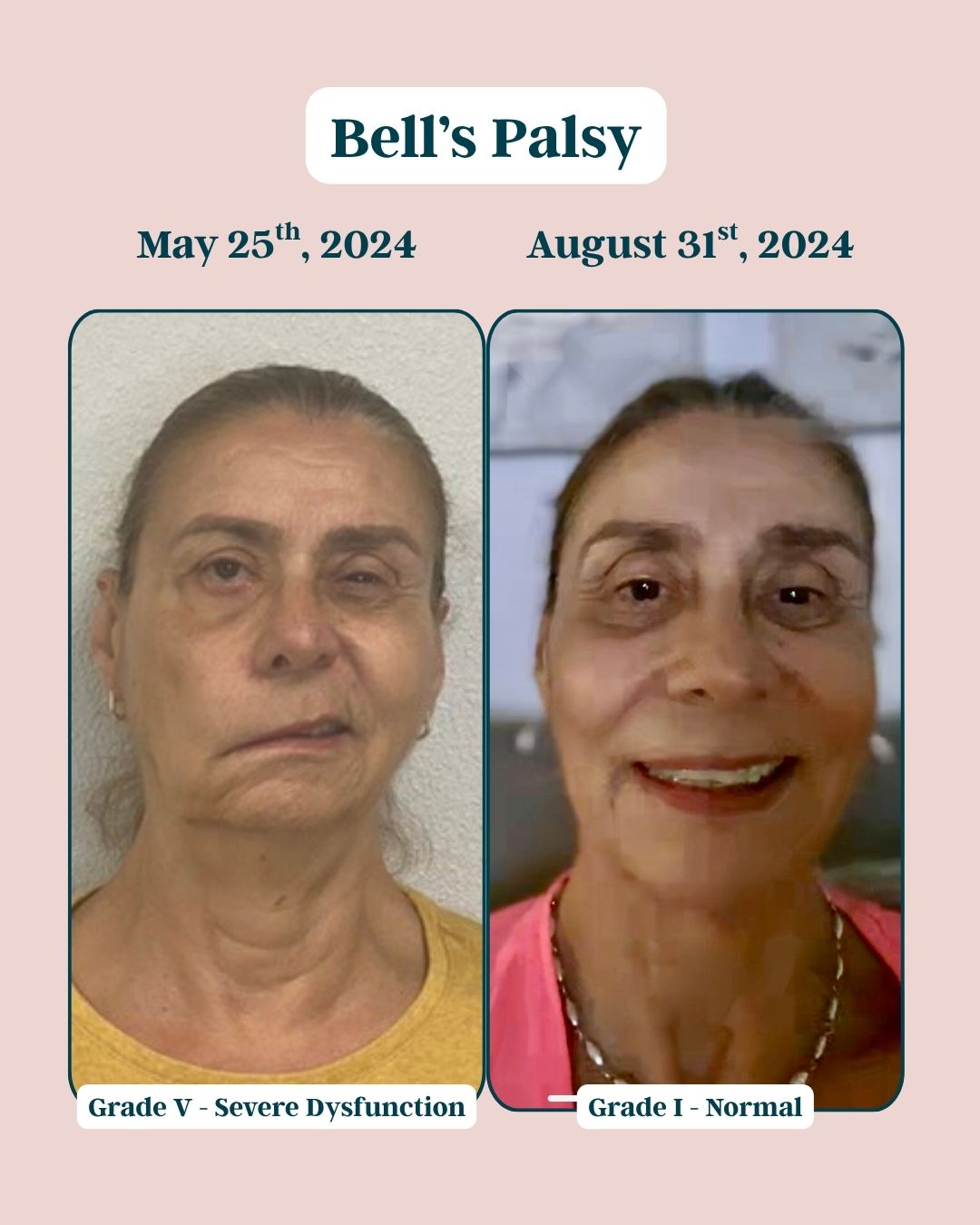 Before and After Bells Palsy 2