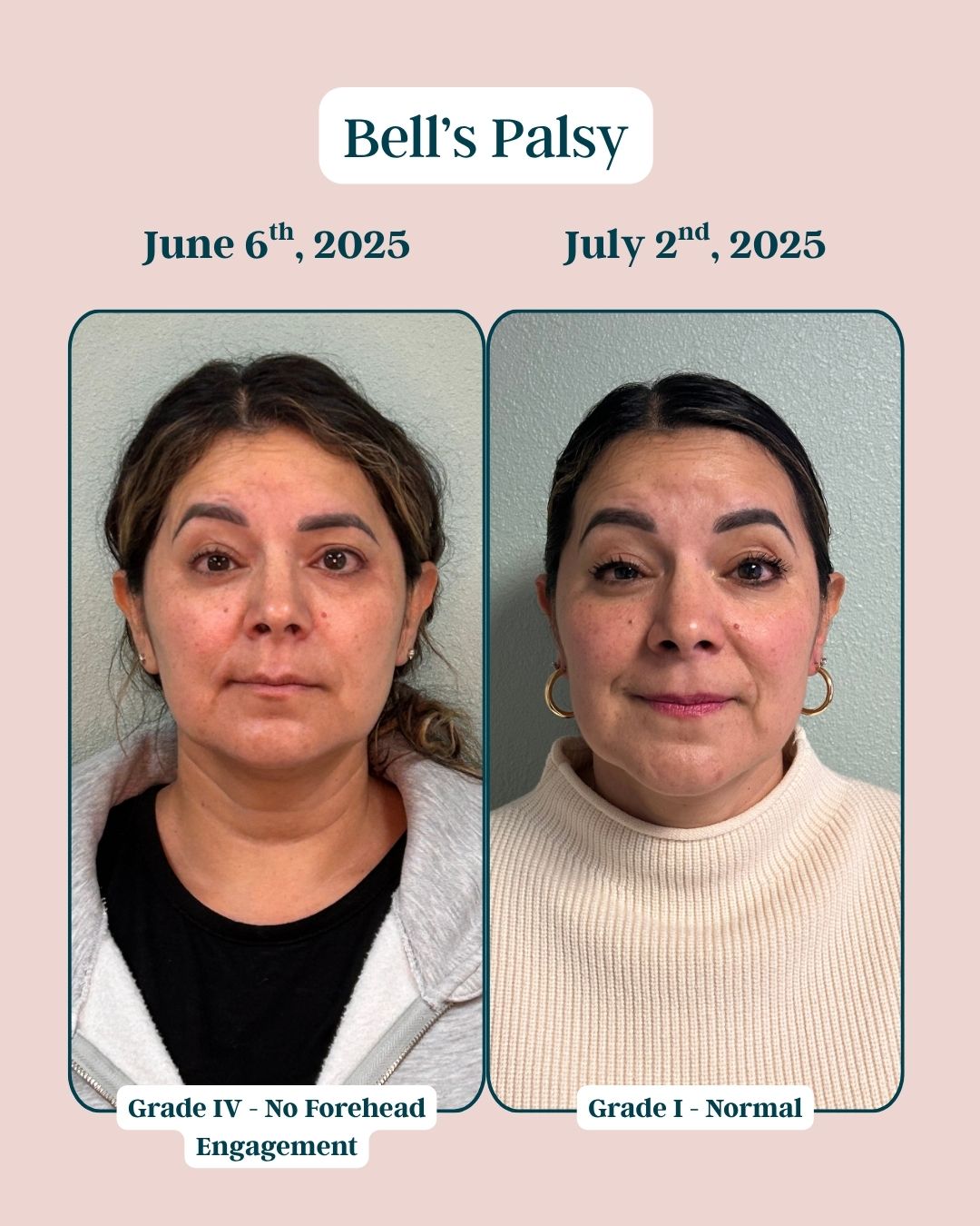 Before and After Bells Palsy 3 (1)