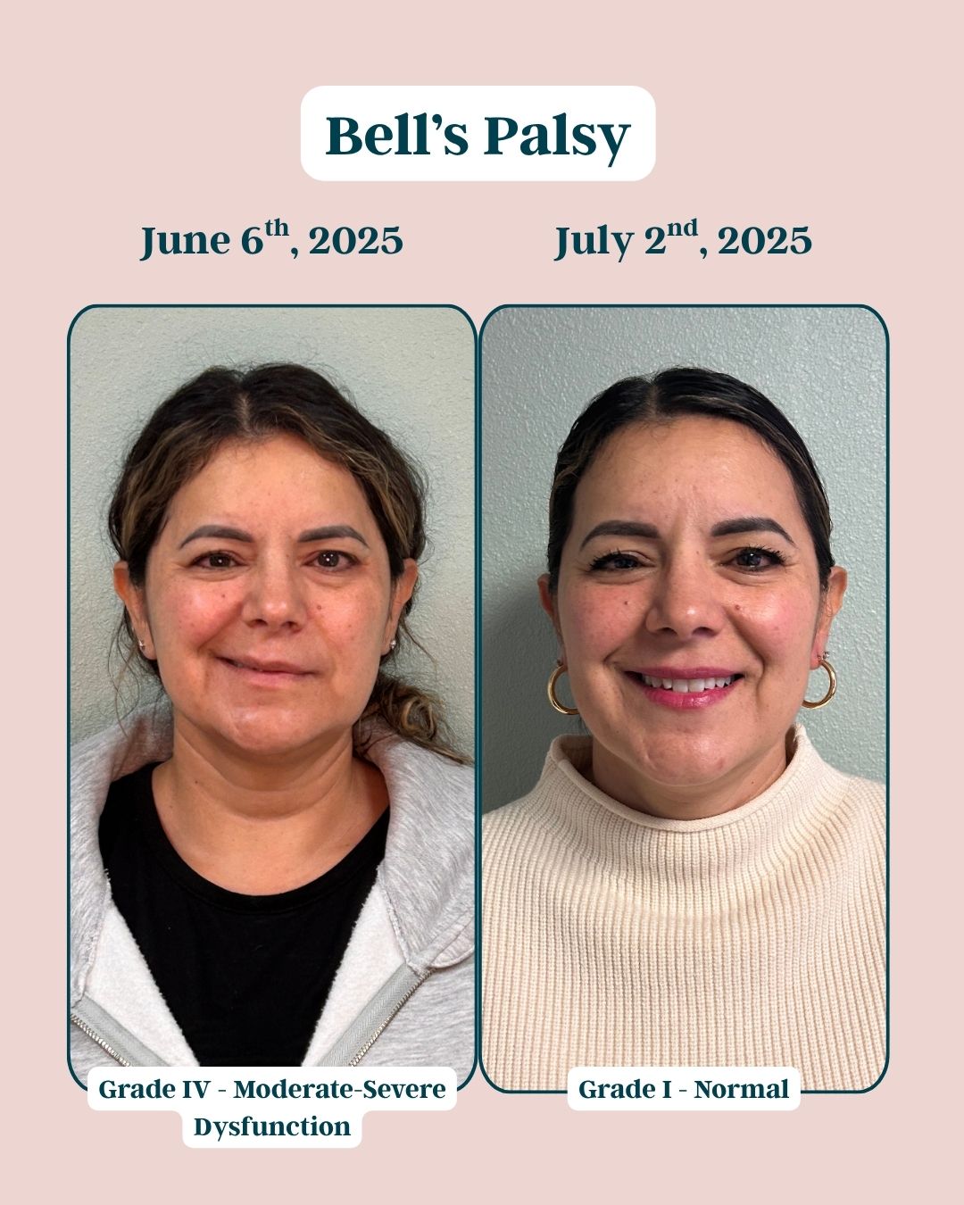 Before and After Bells Palsy 3