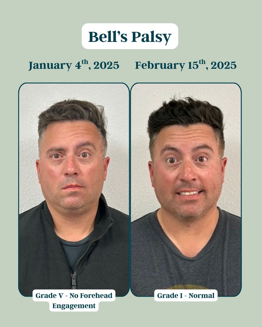 Before and After Bells Palsy 4 (1)