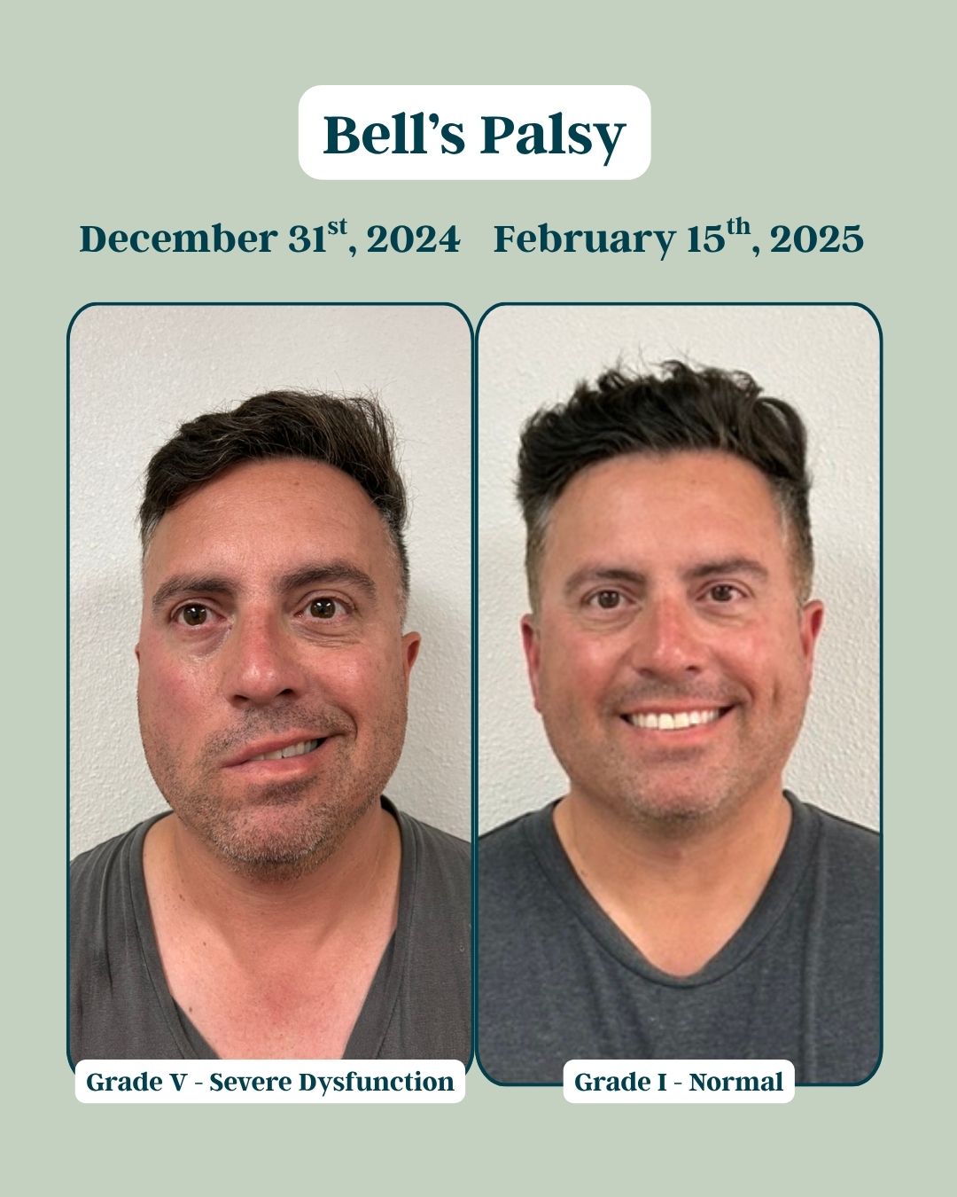 Before and After Bells Palsy 4