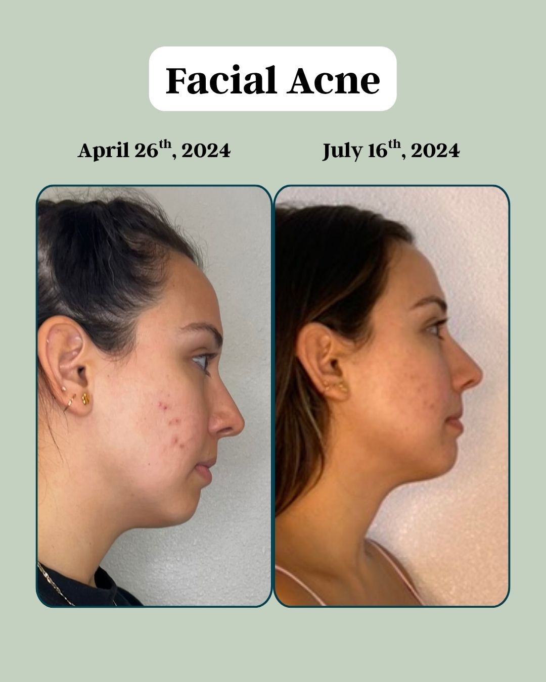 Before and After Facial Acne