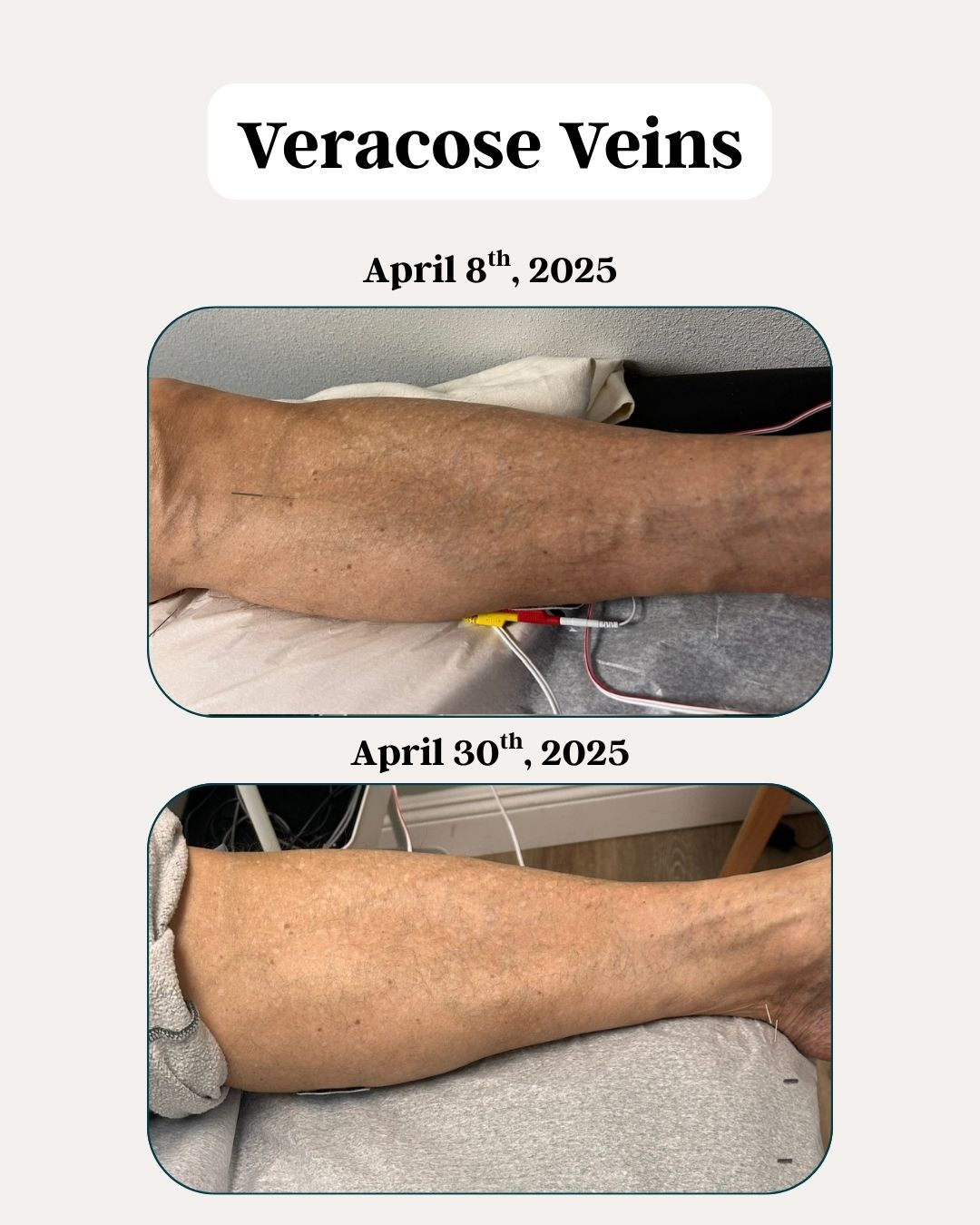 Before and After Veracose Veins
