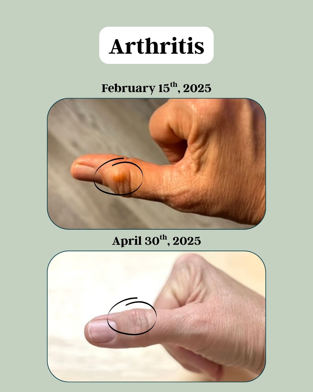 Right Thumb