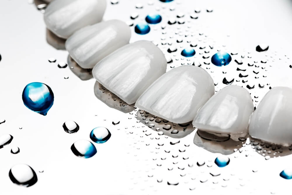 Natural looking ceramic veneers