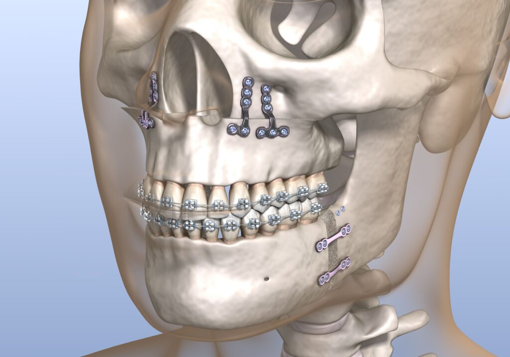 image of orthognathic surgery