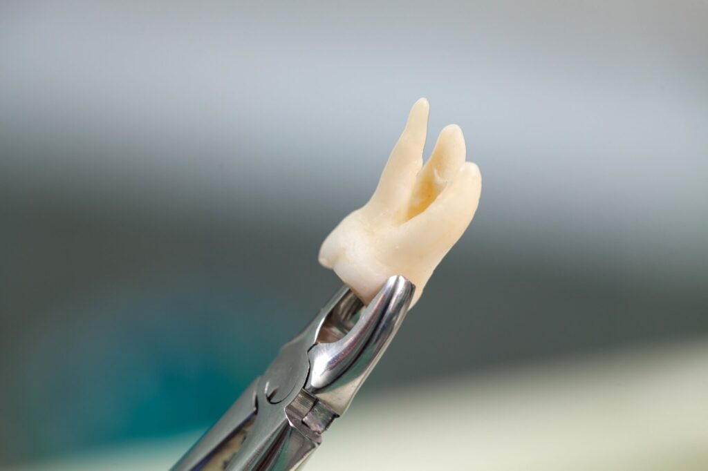 tooth extracted