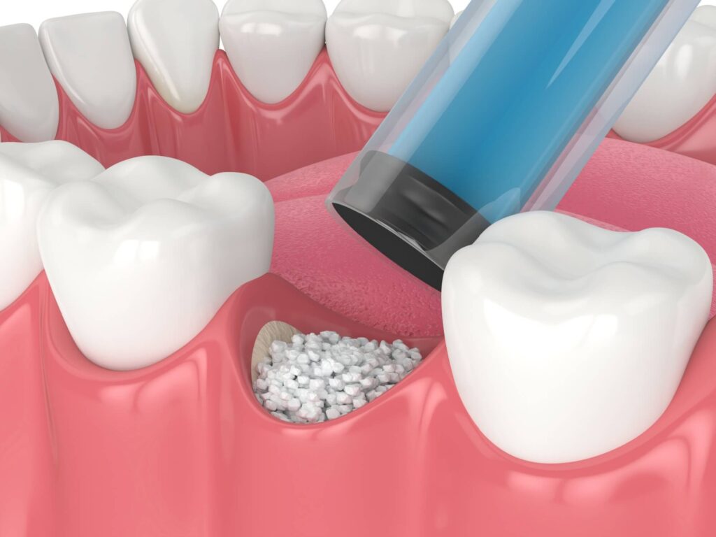 Bone grafting