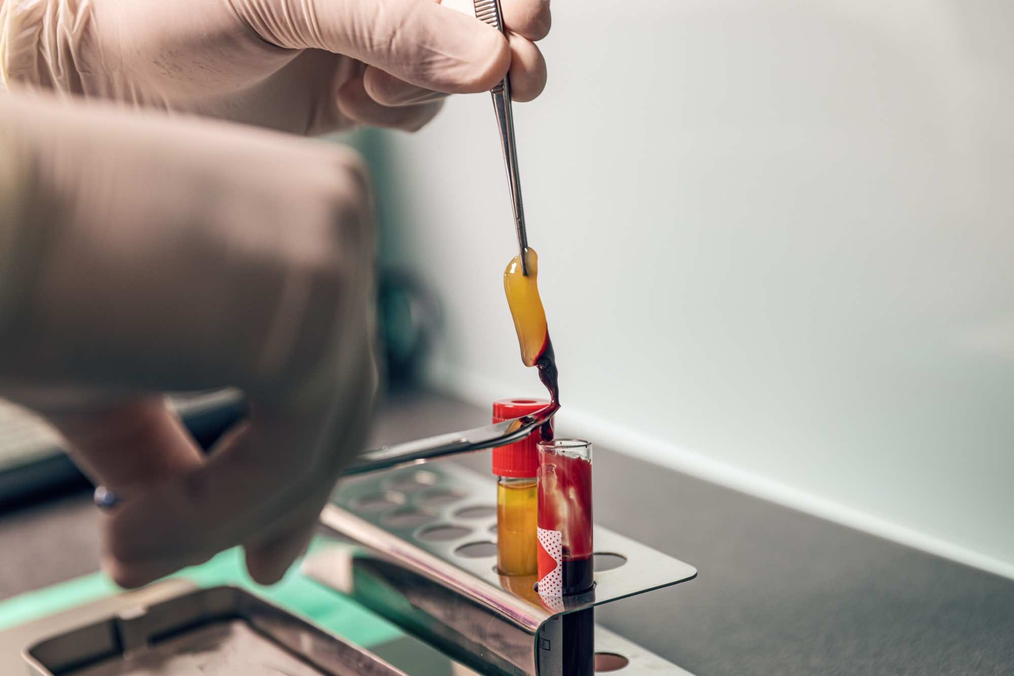 Platelet-rich fibrin (PRF)