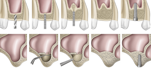 Sinus Lift