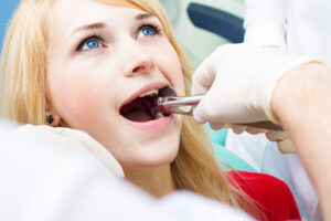 Tooth Extraction, tooth removal, dentist, wisdom teeth, extraction