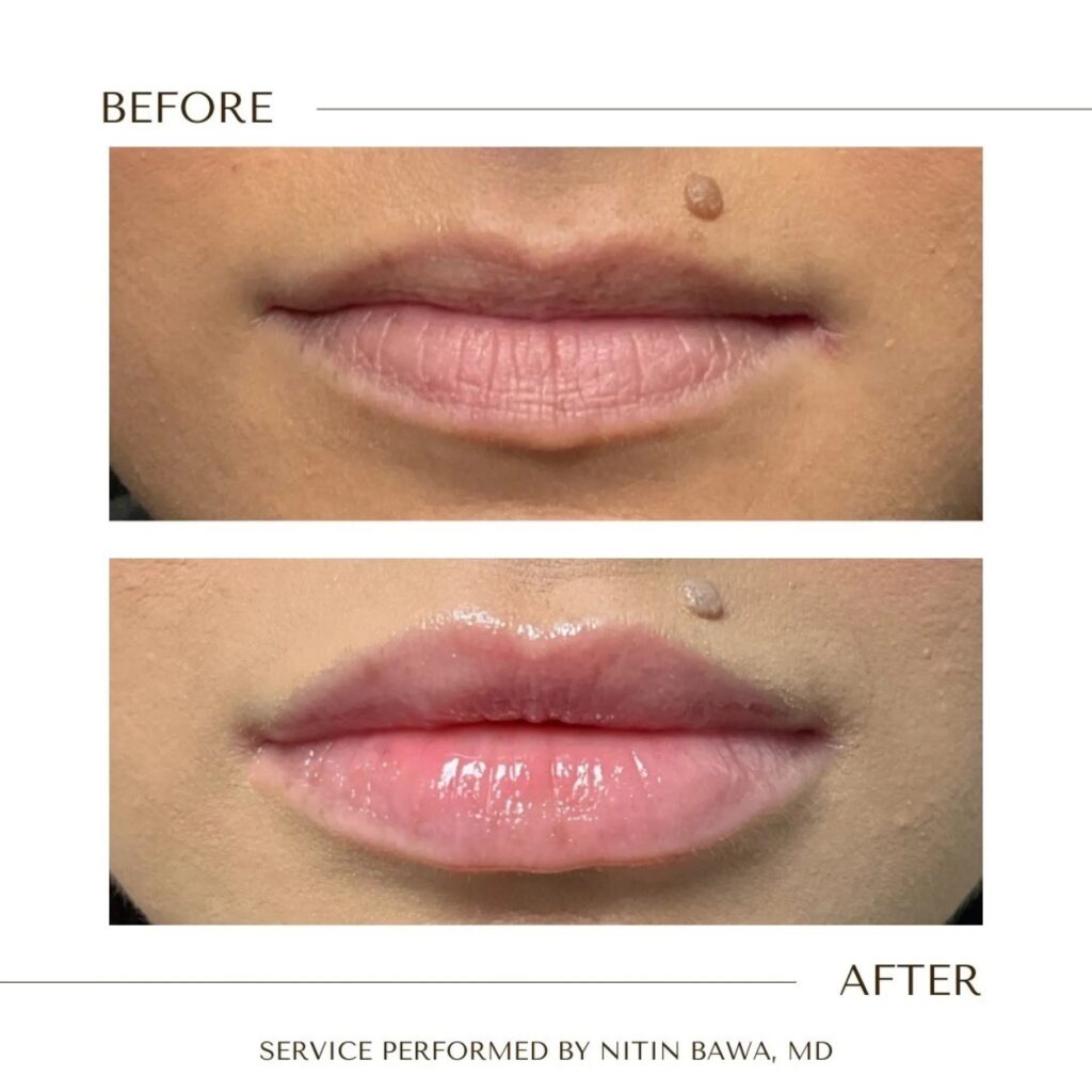 Fillers Before After