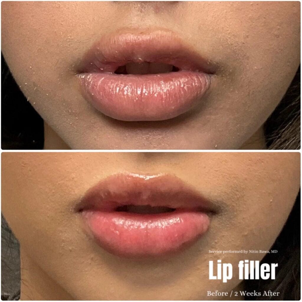 Fillers Before After