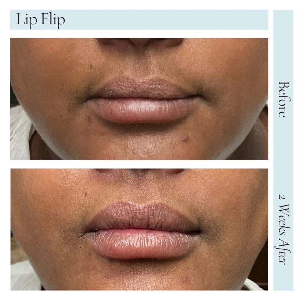 Fillers Before After