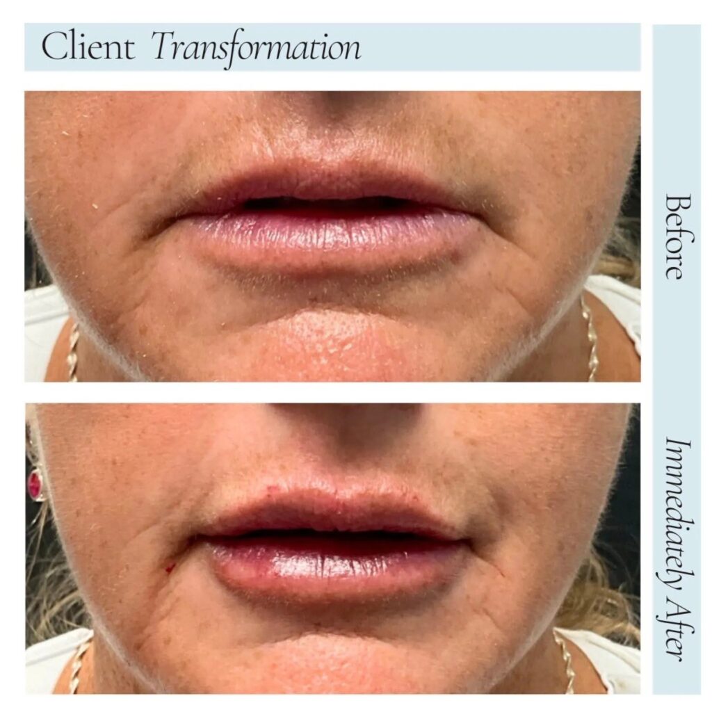 Fillers Before After