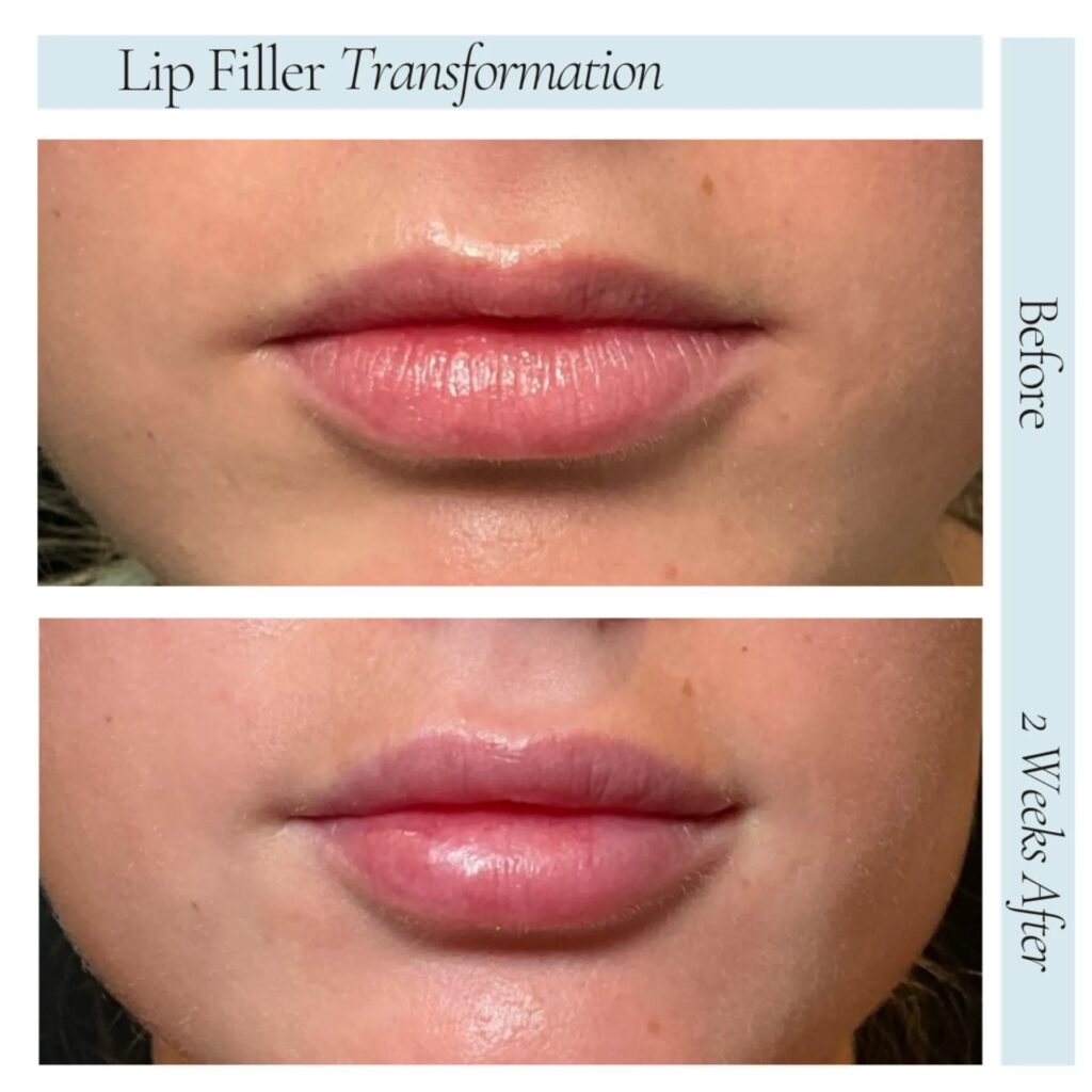 Fillers Before After