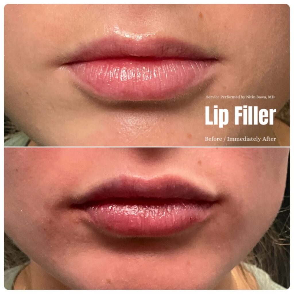 Fillers Before After