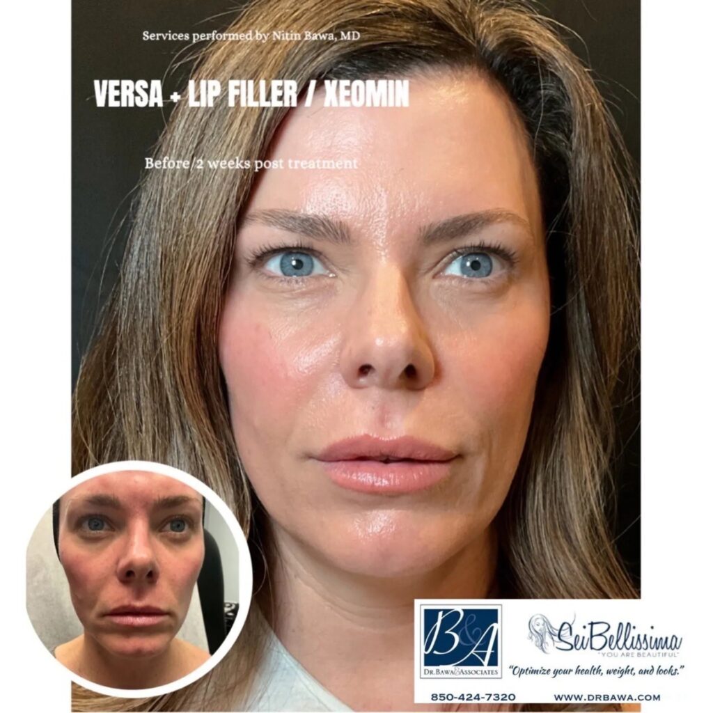 Fillers Before After