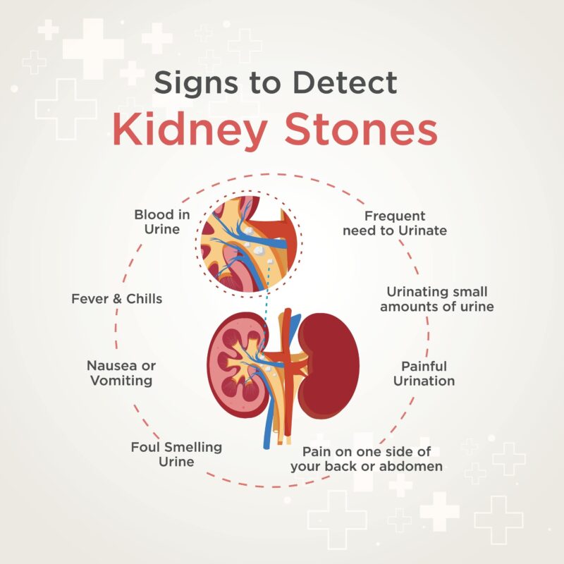 Kidney Stones. Kidney Health Signs. Medical and Health Care Poster Templates Vector