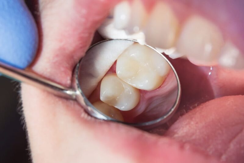 Composite Fillings-