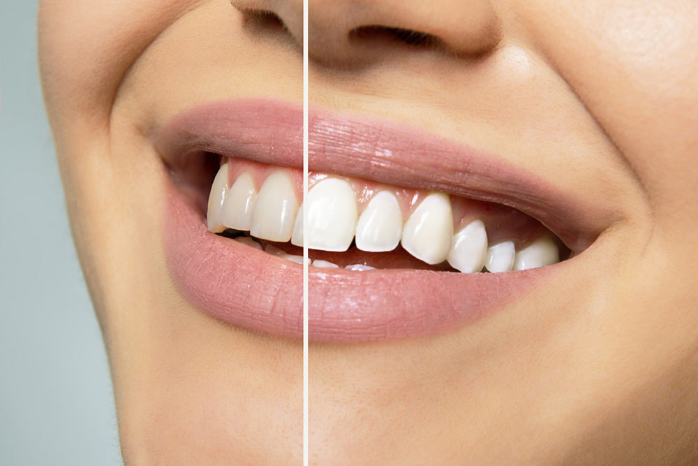 Teeth Whitening