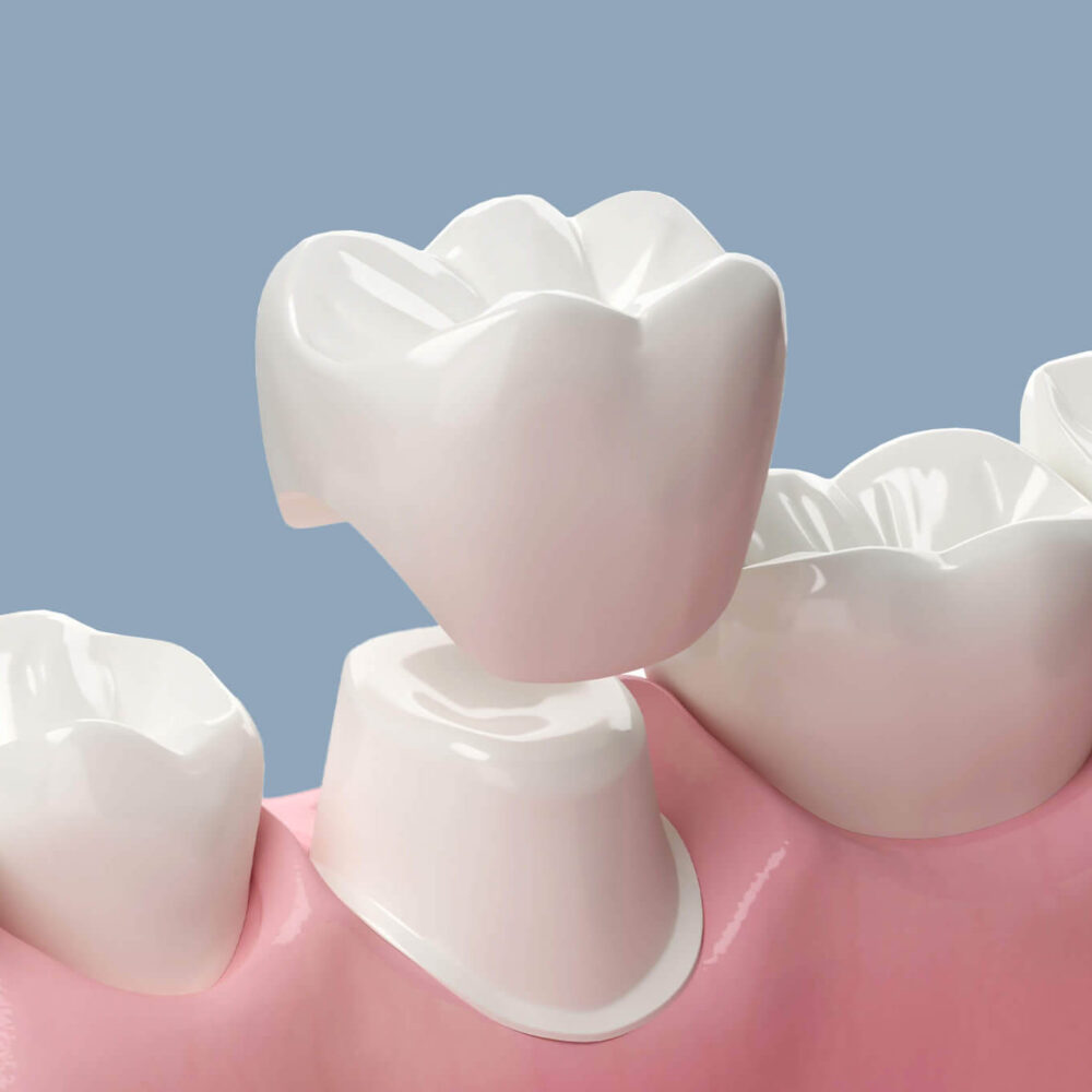 dental crown