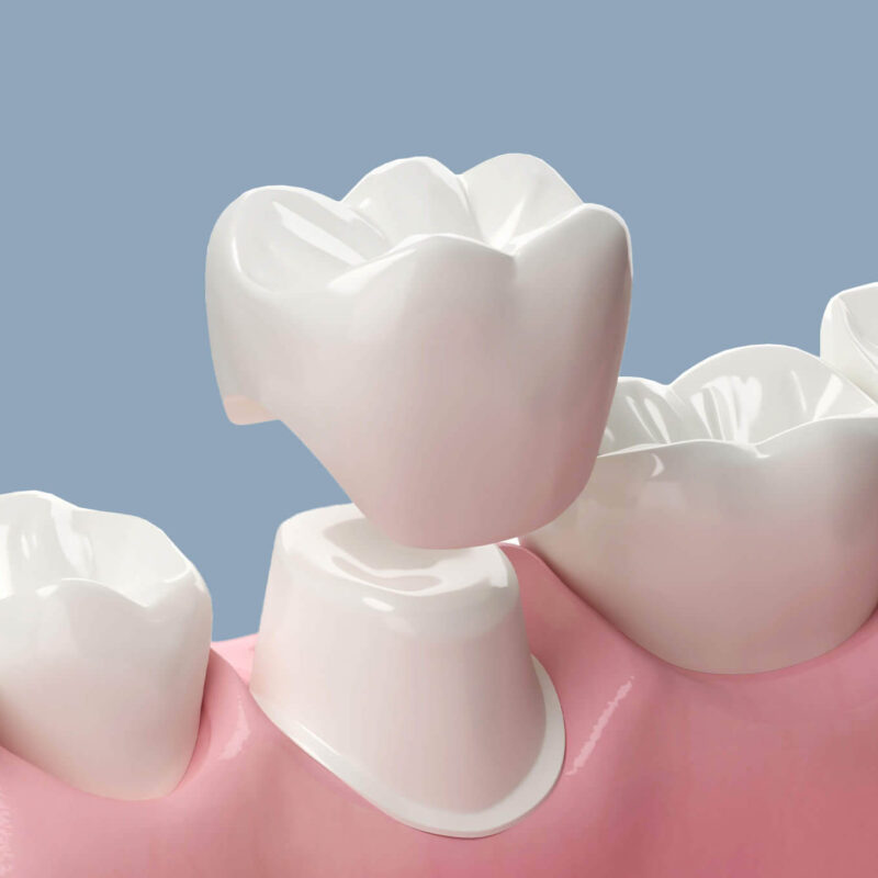 dental crown