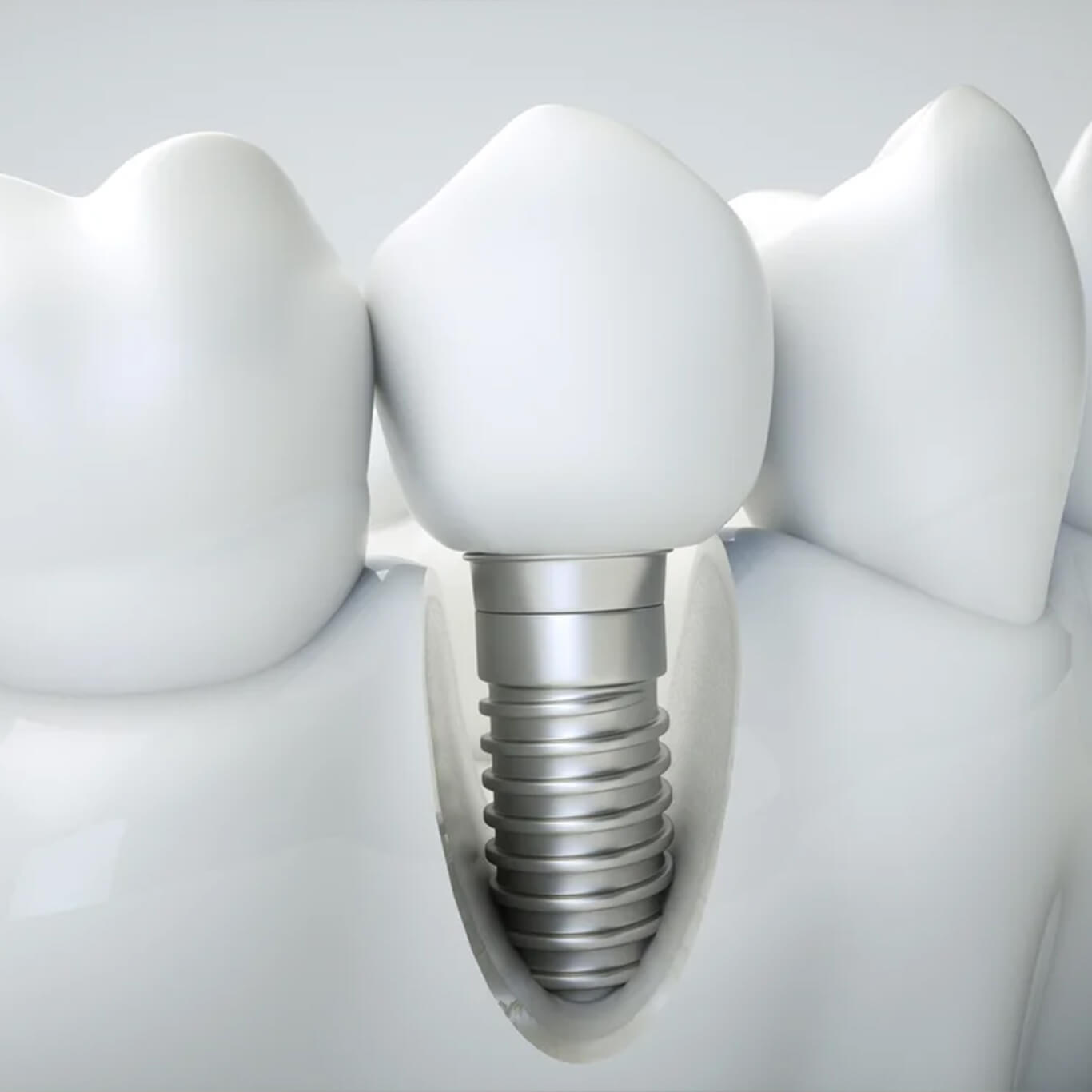 Dental implants