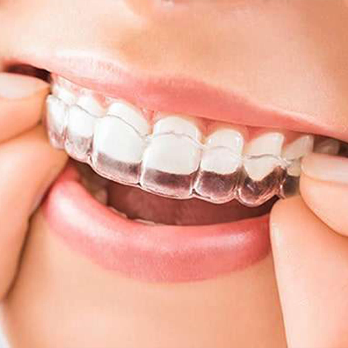 Clear Dental Aligners