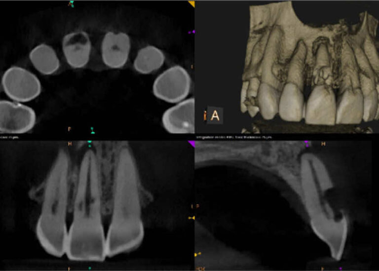 Resorption2