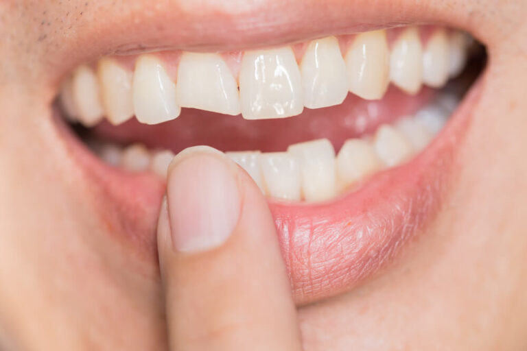 chip tooth