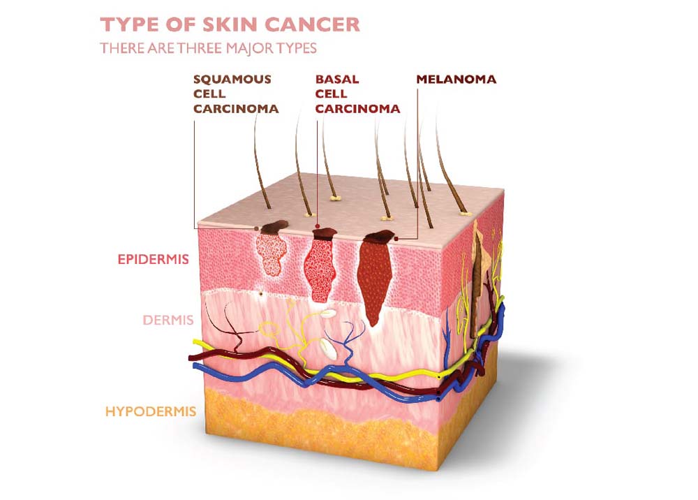 Skin Cancer