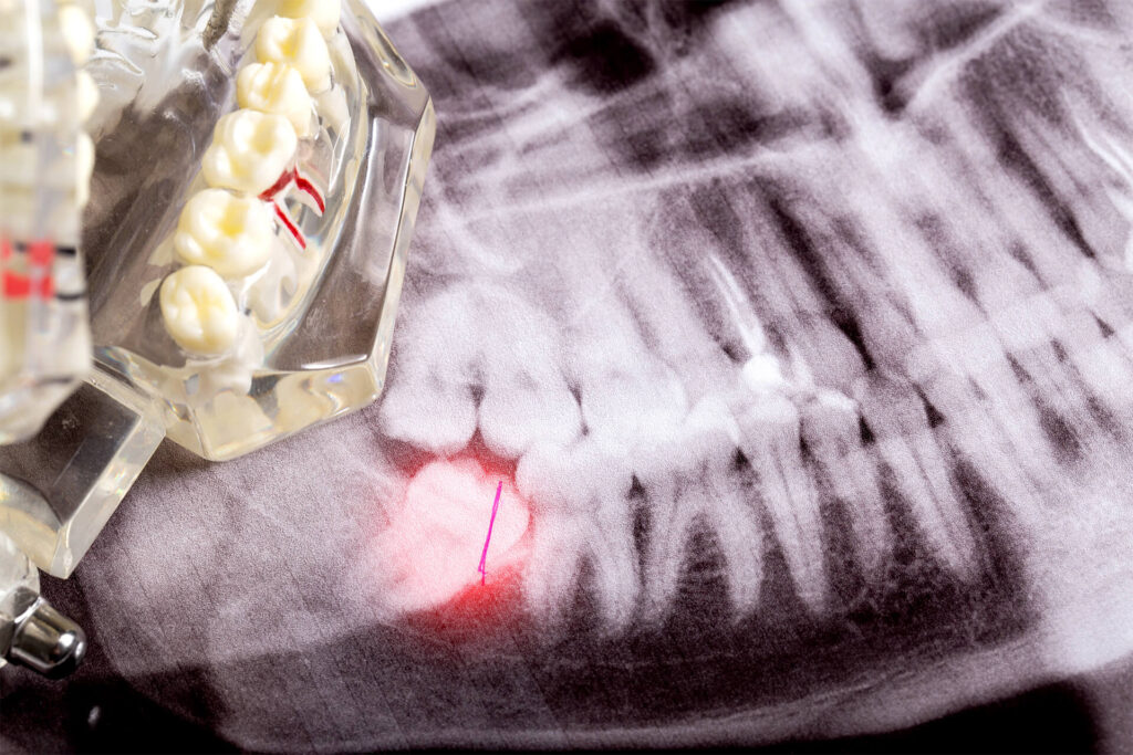 Impacted wisdom teeth on an X-ray picture with an inflamed cyst neoplasm