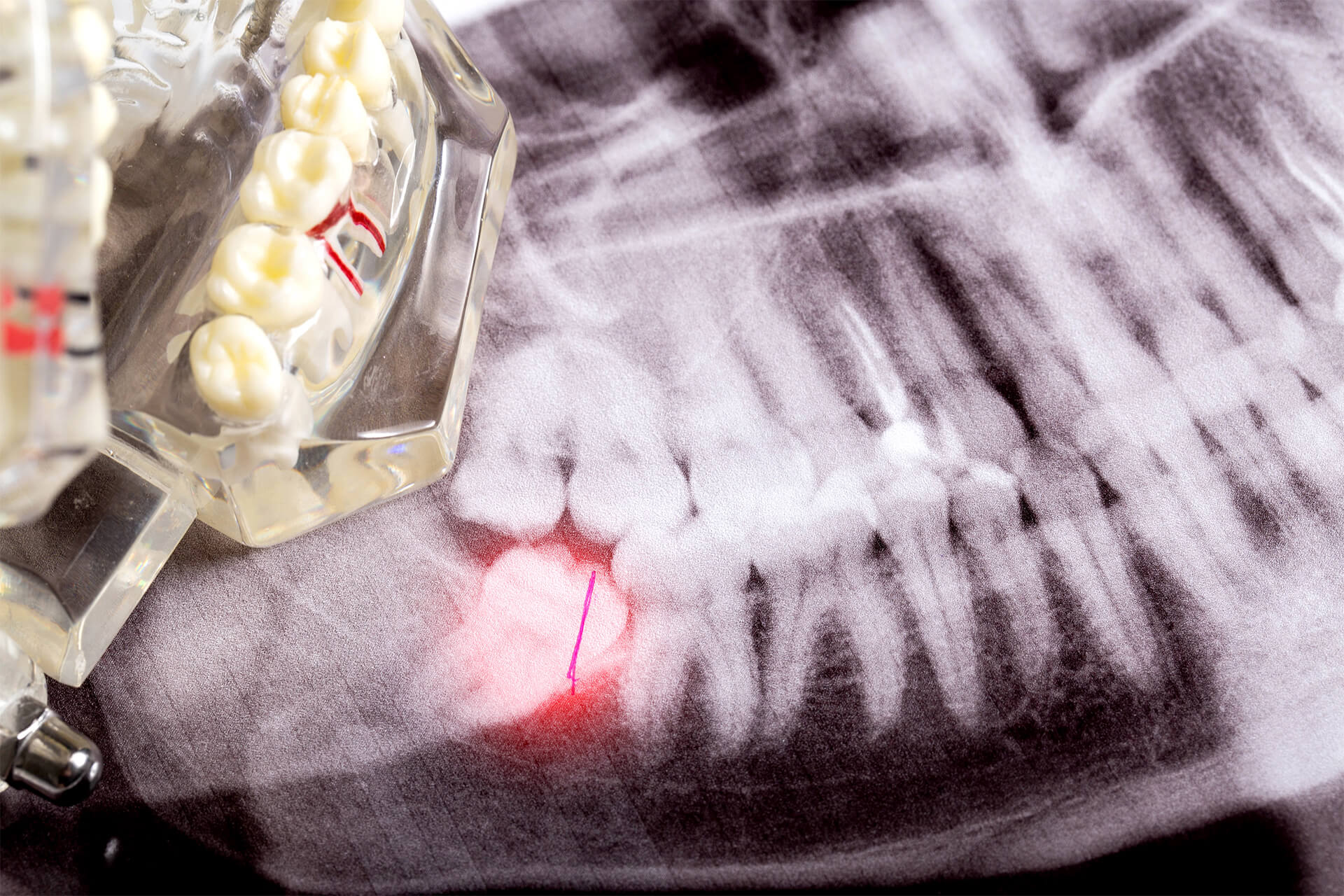 Impacted wisdom teeth on an X-ray picture with an inflamed cyst neoplasm