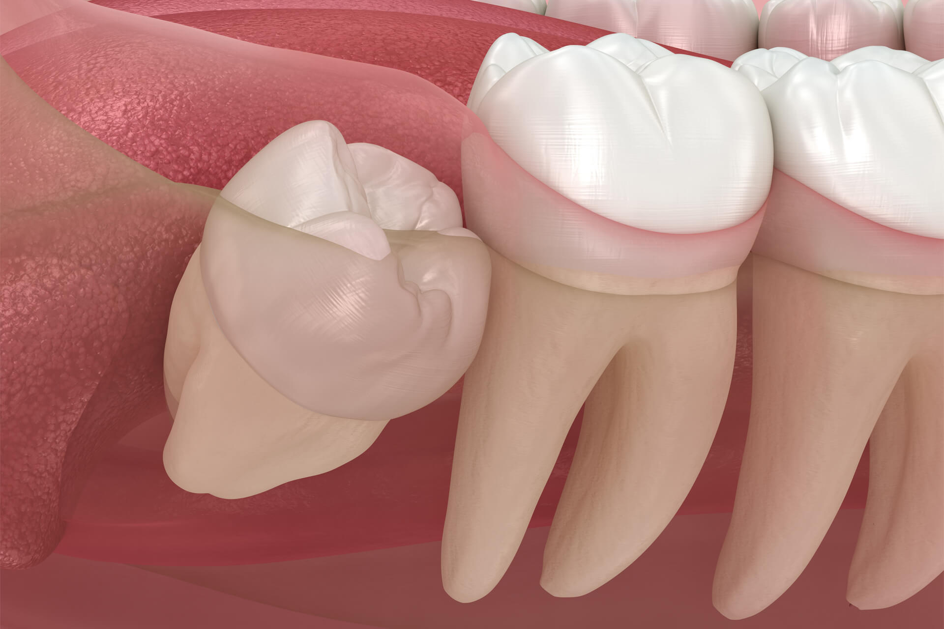 Abnormal position of wisdom teeth