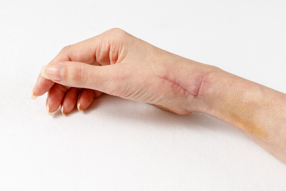 Scar Revision | Borealis Dermatology