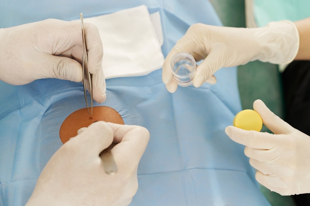 Doctor and nurse during birthmark removal dermatologic surgery