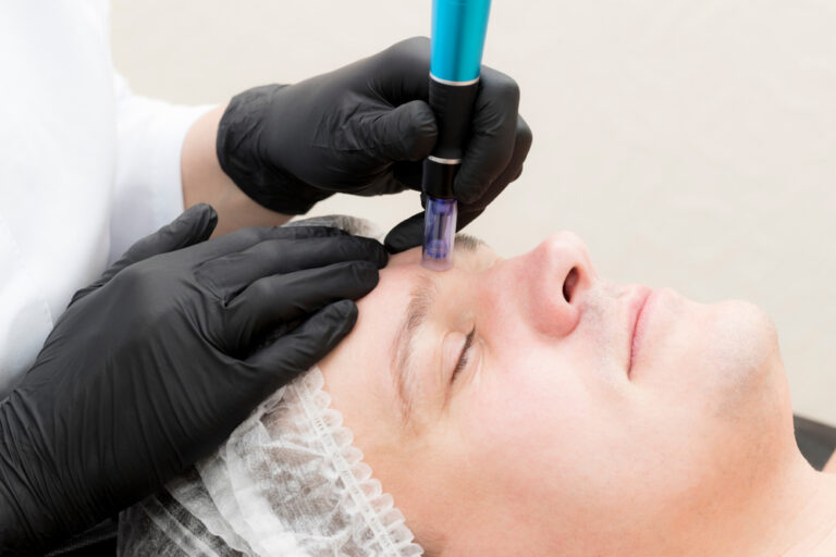 fractional microneedle lifting procedure in a beauty salon for men