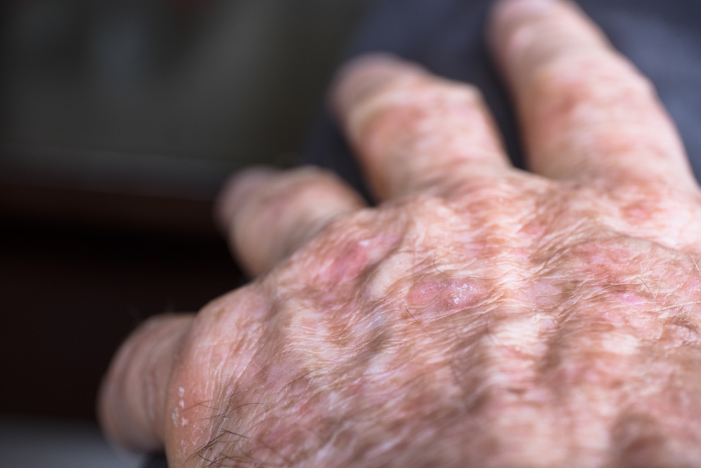 Lesions of actinic keratosis or sunspots on sun-damaged skin of the hand of a man.