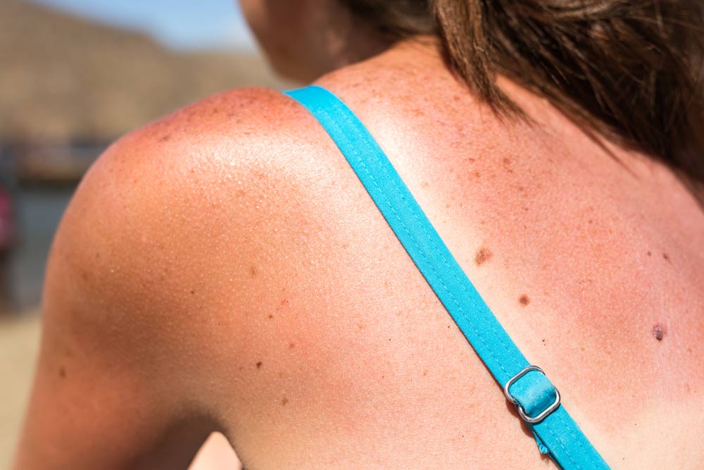 Sunburn from beach sun light on the shoulder and back of caucacian girl