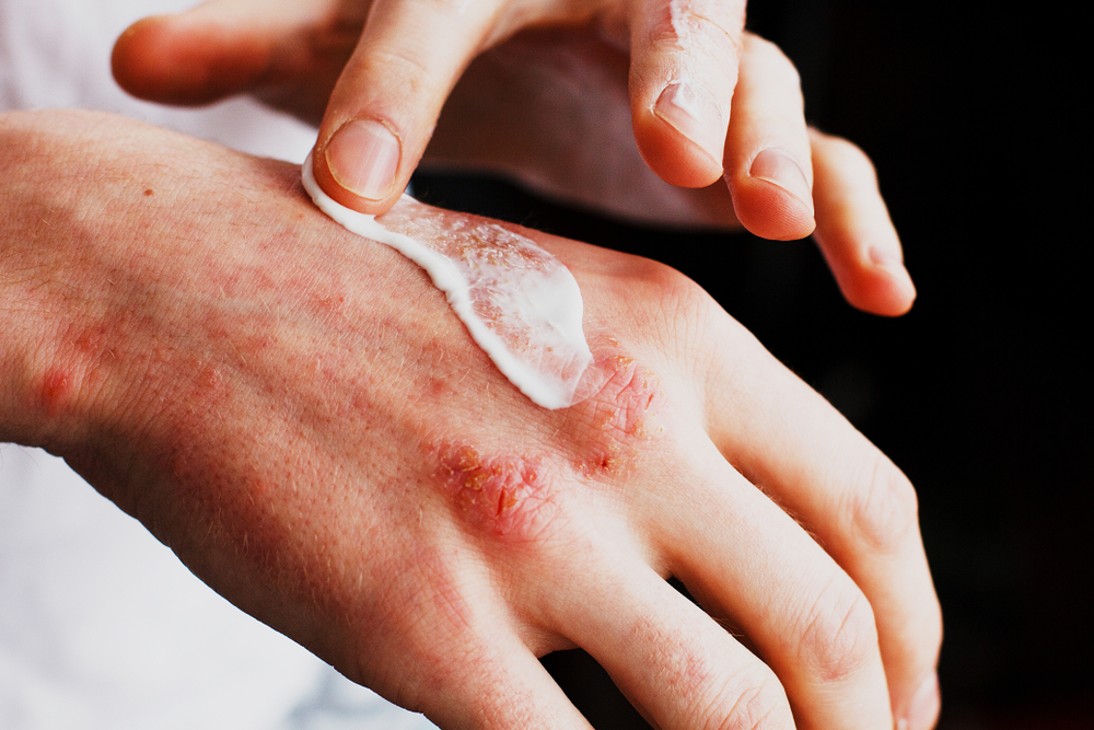Man Applying Ointment for Hand Eczema