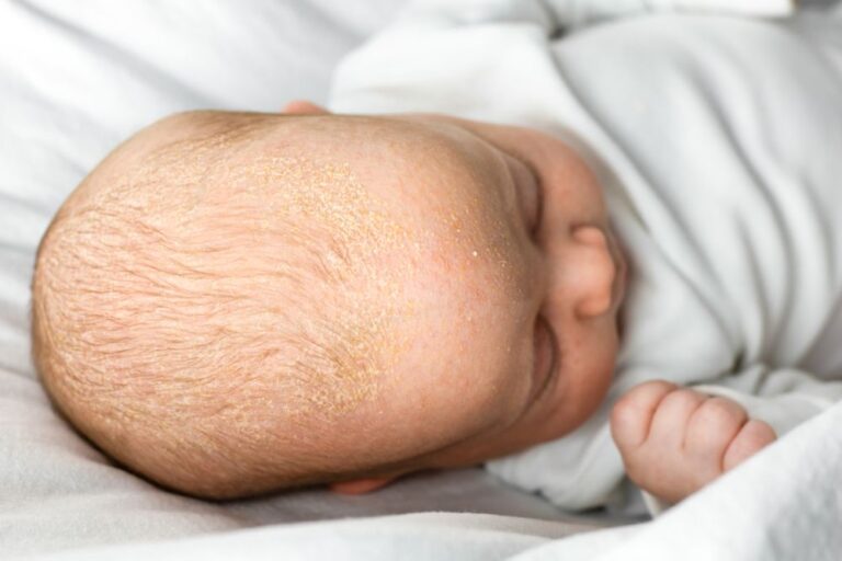 Seborrheic Dermatitis