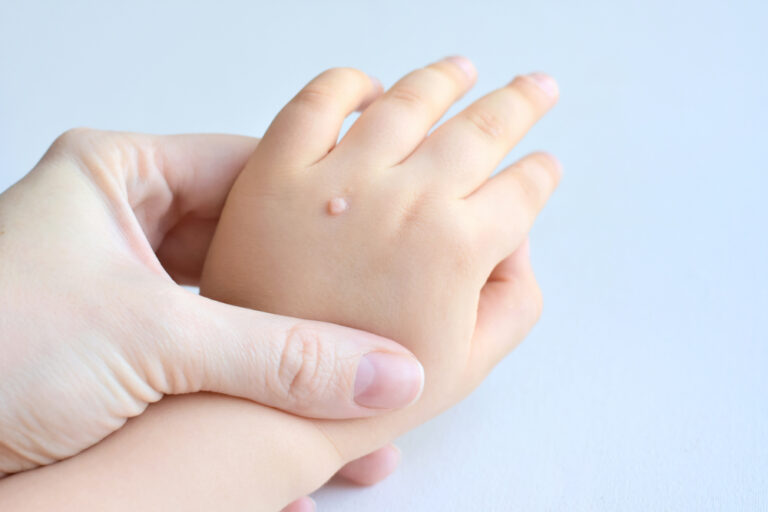 The doctor holds a small hand of a child affected with warts
