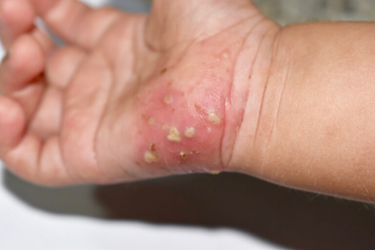 Scabies Infestation with secondary or superimposed bacterial infection in right hand of a child