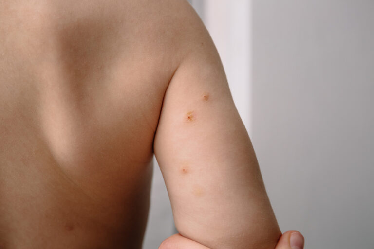 Molluscum Contagiosum Also Called Water Wart in Pediatrics Patients