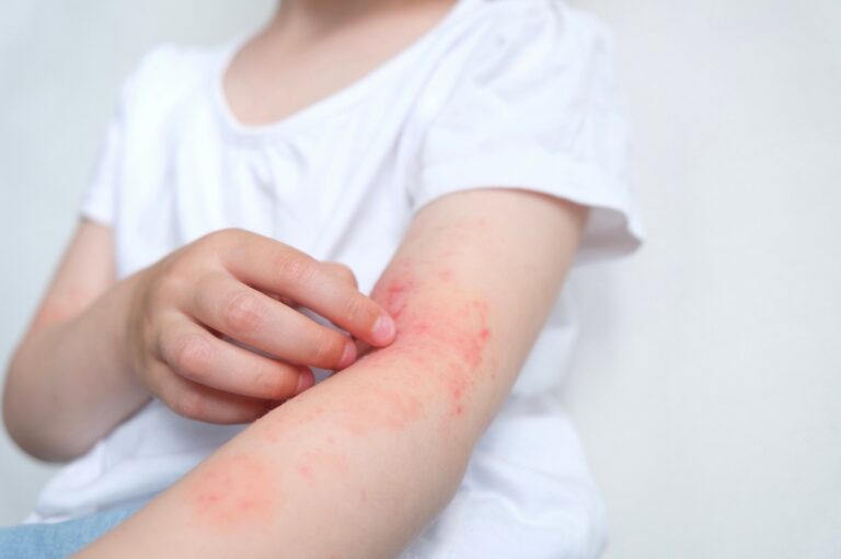 A child scratching atopic dermatitis (eczema)