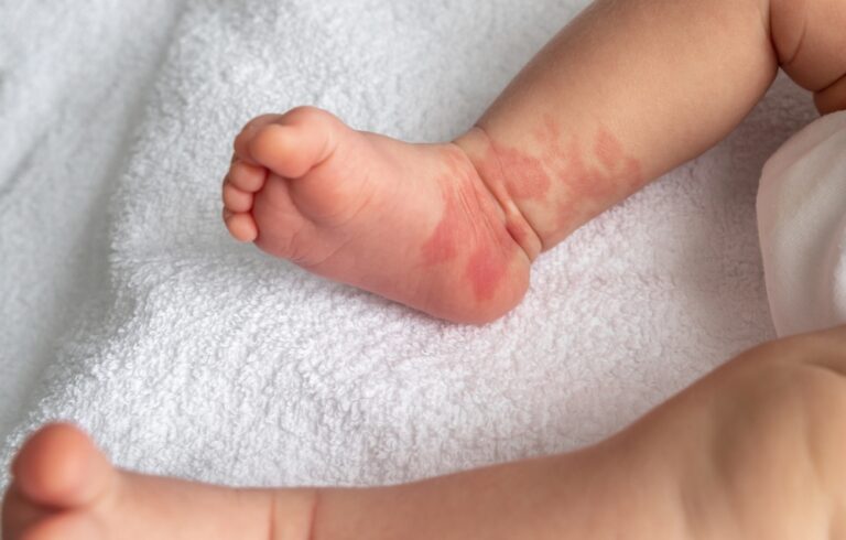 Hemangioma red birthmark on the leg of newborn baby